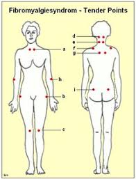 Fibromyalgia is a condition characterized by pain in your muscles and fibrous tissues (such as the tendons and ligaments), accompanied by fatigue, low mood 20 Fibromyalgie In Deutsch Psoriasis Arthritis Ideen Fibromyalgie Arthritis Gesundheit
