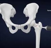 Double Medical Alter Cementless Stem System - Hip Replacement Surgery