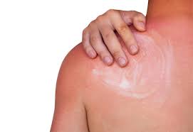 Coconut Oil For Sunburn Does It Work