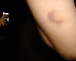 Bug Bite Black And Blue Ring What Bit Me Identifying Bites And Stings The Infinite Spider