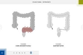 Dopo la fase acuta, si può tornare alla gradualmente alla propria dieta, ma mantenendo alcuni accorgimenti nutrizionali. La Diverticolite Acuta Sintomi E Percorso Di Cure Gemelli Curae