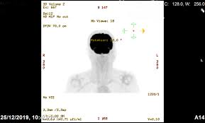 Understanding the nature of cancer. Cureus Positron Emission Tomography With Fluorodeoxyglucose Incidental Detection Of Colon Cancer In A Patient S Follow Up For Nasopharyngeal Carcinoma During The Covid 19 Pandemic A Case Report