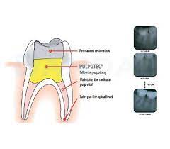 The use of pulpotec after a pulpotomy performed with laser is also recommended. Pd Pulpotec Dandal