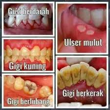 Gigi yang berlubang akan menimbulkan sakit berdenyut kalau sudah mencapai ruang pulpa yang isinya adalah jaringan syaraf dan pembuluh darah. Facebook