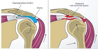 The shoulder joint itself is a ball and socket joint that is part of the larger anatomy of what is known as the shoulder girdle or shoulder capsule. Shoulder Impingement Syndrome How To Prevent It Spd