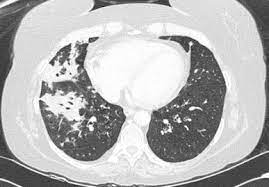 May 27, 2021 · ワクチン接種者の母乳中の抗体 3ヶ月前; A Rare Case Of Raoultella Planticola Pneumonia An Emerging Pathogen Sciencedirect
