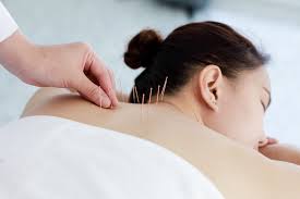 Image result for Acupuncture
