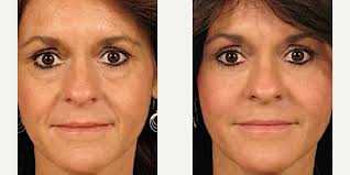 Aura Laser Skin Care