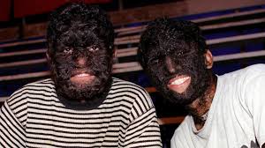 Image result for Hypertrichosis