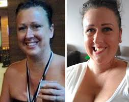 My wonky smile has inspired thousands' Mum whose face was ravaged by skin  cancer because she NEVER wore sun cream shares candid photos