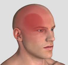 Headaches — Adventure Physiotherapy