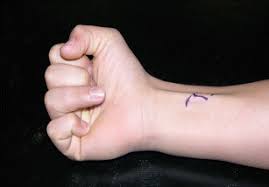 The flexor tendons of the hand play a very important role in functioning of the hand. A Review Of Mallet Finger And Jersey Finger Injuries In The Athlete Springerlink