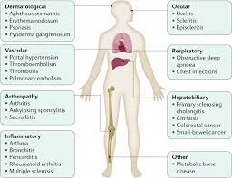 Crohn S Disease Nature Reviews Disease Primers
