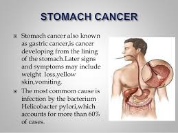 The most most common sign of testicular cancer is a lump or swelling that's the size of a pea or larger in part of one testicle. Cancer
