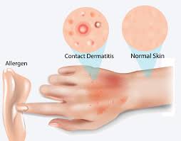Image result for dermatitis contacta allergica