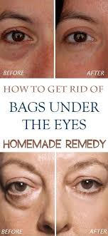 Top 4 Homemade Remedies For Bags Under Eyes Beauty Remedies Skin Care Tips Under Eye Bags