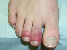 Image result for Chilblains