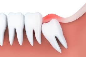 Simple wisdom tooth extraction cost. How Much Does It Cost To Remove Your Wisdom Tooth