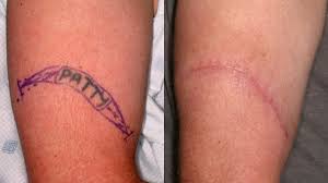 Allan 3 february 2014 at 02:49. Laser Tattoo Removal Tattoo Surgery And Other Methods All You Need To Know Visakha Institute