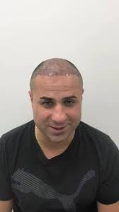 Get your hair back permanently with FUE technique. No cutting-No stitches  Call 1-844-774-4247