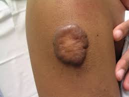 Usually, a steroid injection is the best treatment for keloids on the chest and shoulder. Keloids Pathophysiology And Management