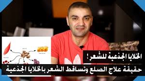 حقيقة علاج تساقط الشعر والصلع بالخلايا الجذعية Youtube