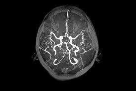 Image result for Brain Lesion