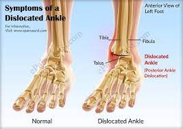 Symptoms Of A Dislocated Ankle Or Ankle Dislocation Dislocated Ankle Broken Ankle Treatment Recovery