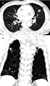 They can often be measured. Ct Halo Sign Radiology Key