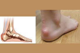 Deformidade haglund de no calcanhar: Haglund S Deformity Dr Babajide A Ogunlana Dpm Facfas Wes