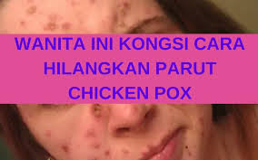 Cara hilangkan parut jerawat, ampang. Wanita Ini Kongsi Cara Hilangkan Parut Chicken Pox Coach Bisnes Coach Detox Kurus Coach Penyusuan Susu Ibu Mentor Bisnes Pengedar Shaklee Pengedar Youth Pengedar Vivix 011 17547669