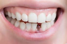 Image result for dental implant