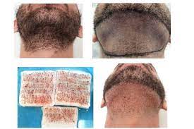 We did not find results for: Beard Grafts For Hair Transplantation Maral Hair