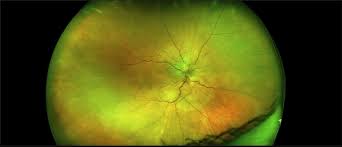 The retina is a sensitive membrane within your cat&rsquo;s eye that receives light impulses through the lens. Serous Retinal Detachment And Retinal Infiltrate Due To B Hensele Cat Scratch Disease Retina Image Bank