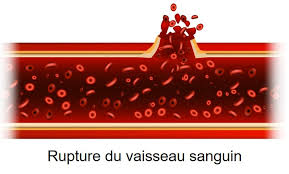 • risque hémorragique à évaluer pour la. Accident Vasculaire Cerebral