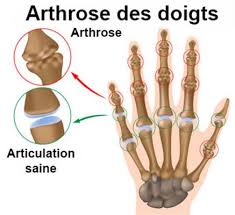 Des douleurs une accentuation de la douleur lors de mouvements ou lors d'une activité (sport, port d'une charge…) Arthroses Des Doigts Symptomes Traitement Definition Docteurclic Com