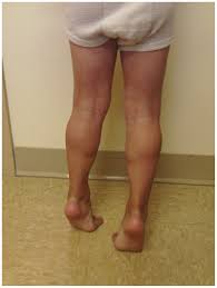 Image result for Muscular Dystrophy