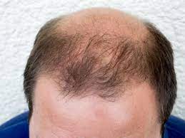 About this item dht can cause the hair follicles to shrink and over time stop the growth of new hair. Dht Dihydrotestosterone What Is Dht S Role In Baldness