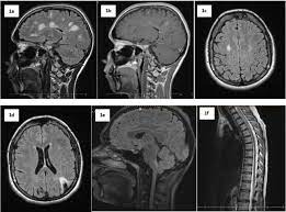 Multiple sclerosis can cause a variety of symptoms: Differential Diagnosis Of Multiple Sclerosis And Other Inflammatory Cns Diseases Multiple Sclerosis And Related Disorders