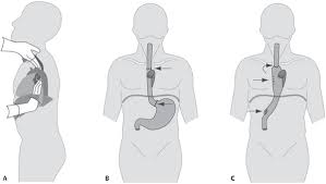Minimally invasive esophagectomy (mie) has consistently been associated with improved perioperative outcome and similar oncological safety compared to open esophagectomy. 193 Postoperative Esophagectomy Chest Radiology Key