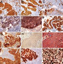 These types of cancer spread more quickly and aggressively. Putative Stem Cell Markers In Non Small Cell Lung Cancer A Clinicopathologic Characterization Journal Of Thoracic Oncology