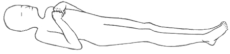 Decorticate Rigidity
