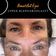 Cosmetic Upper Eyelid Surgery (Blepharoplasty)