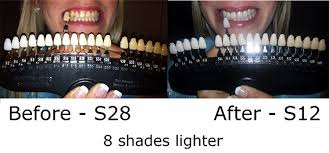Teeth Whitening 3d Shade Guide R20 Shades Teeth Color Dental Dentist Shade Chart Buy 3d Shade Guide 20 Shades Teeth Color Dental Shade Chart Product