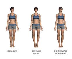Genu Recurvatum Is Also Known As Knee Hyperextension Or Back Knee Knee Bends In Backward Direction In Bow Legged Correction Bow Legged Knock Knees Correction