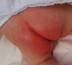 Image result for diaper dermatitis