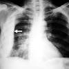 Obliteration of left costophrenic angle with a wide pleural based dome shaped opacity projecting into. Https Encrypted Tbn0 Gstatic Com Images Q Tbn And9gcsgrukgajjvubz Ob1ttxonmlpcgpc9zpagjojsceq Usqp Cau