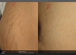 1540 fractional laser before and after. 1540 Laser Skin Rejuvenation Newport Medical And Wellness Center