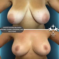 breast sagging causes Archives - Vivid Clinic | Cosmetic Surgery Istanbul,  Turkey