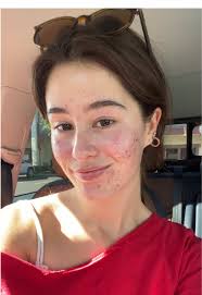 Before and After Facial: Acne Transformation Journey